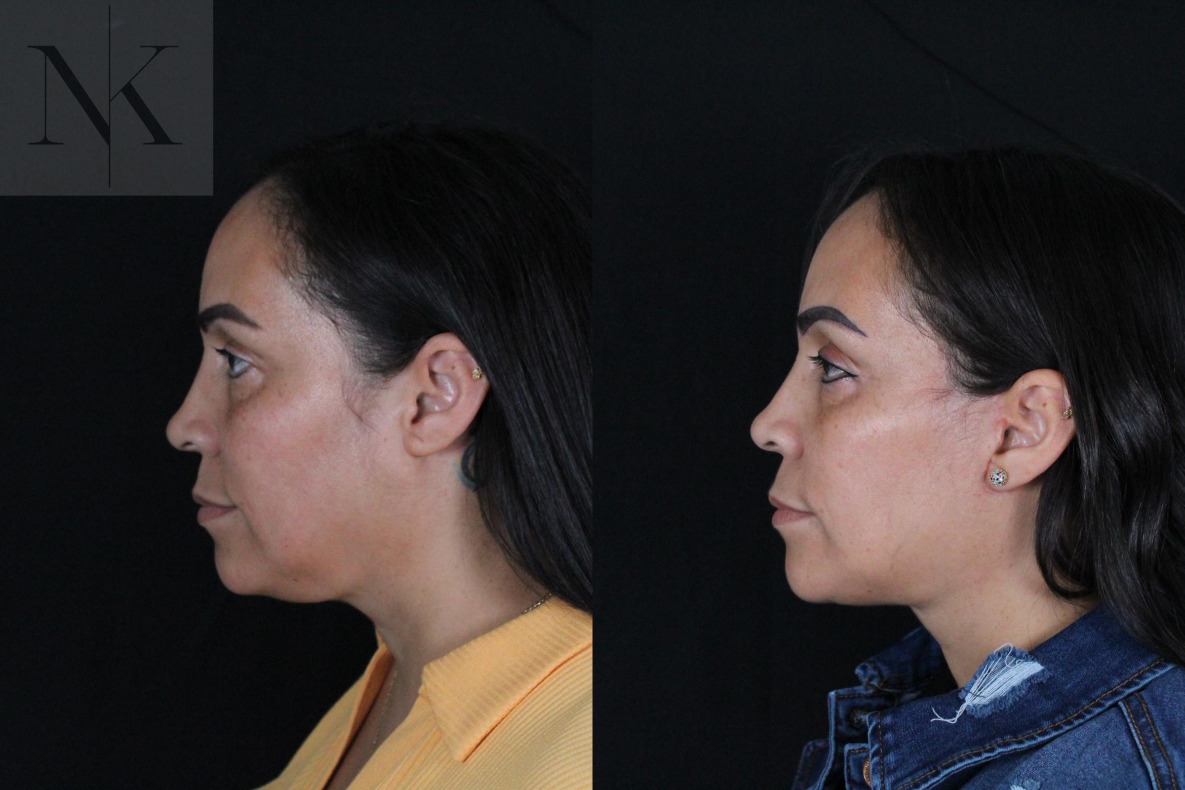 Before & After Deep Plane Facelift Case 212 Left Side View in Wethersfield, Hartford, Nebraska