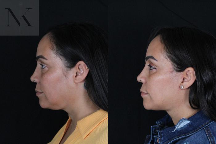 Before & After Deep Plane Facelift Case 212 Left Side View in Wethersfield, Hartford, Nebraska