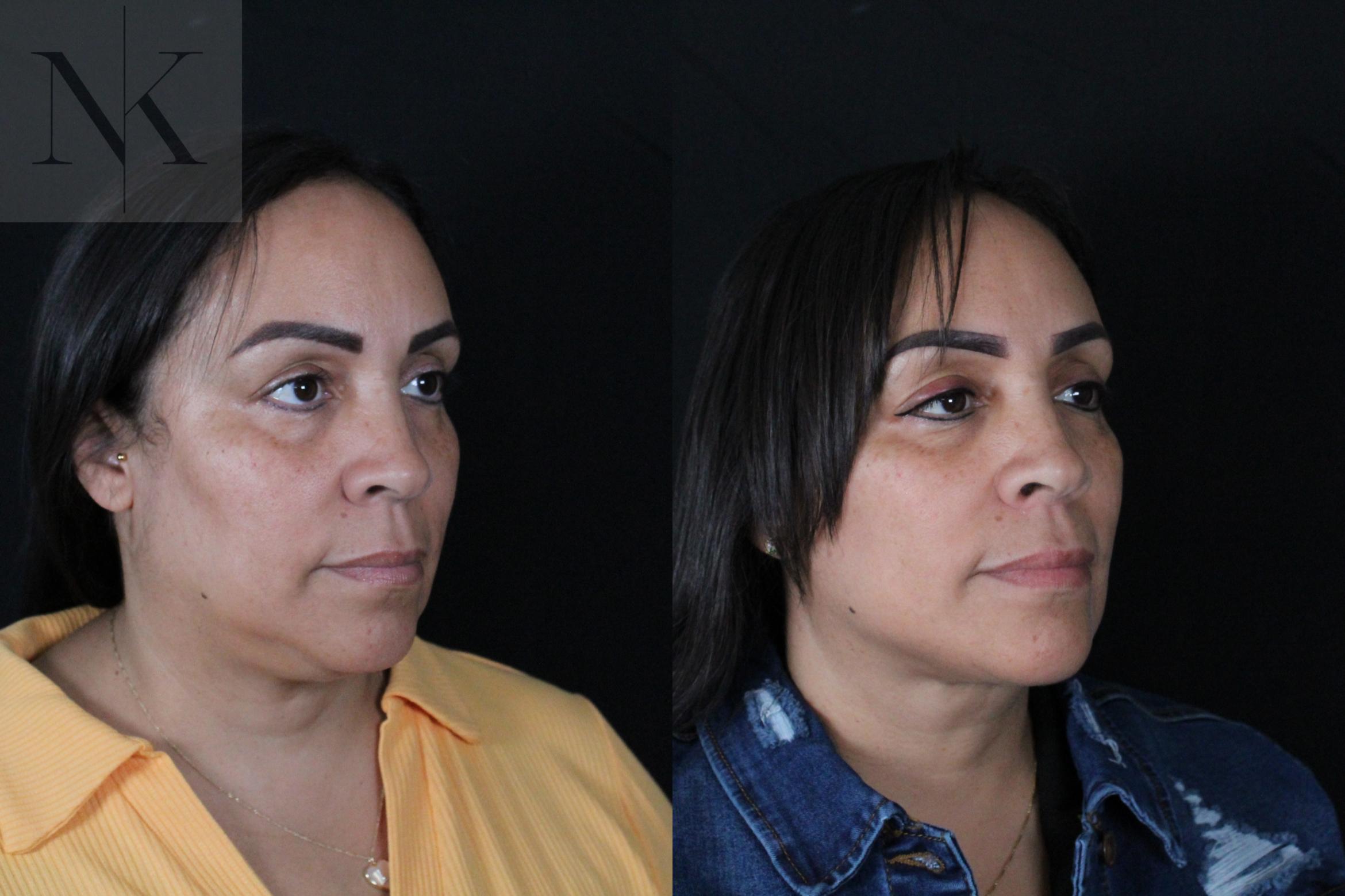 Before & After Deep Plane Facelift Case 212 Right Oblique View in Wethersfield, Hartford, Nebraska