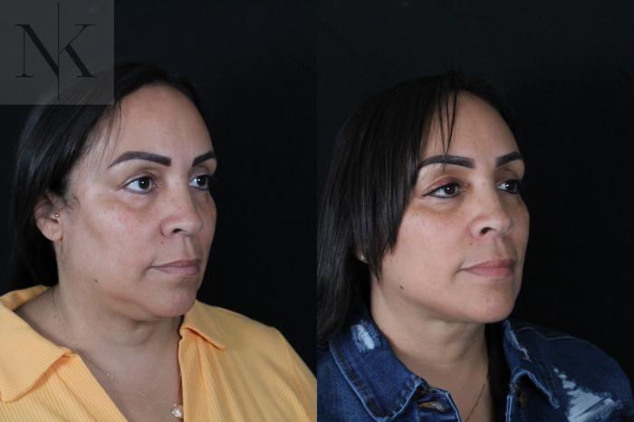 Before & After Deep Plane Facelift Case 212 Right Oblique View in Wethersfield, Hartford, Nebraska