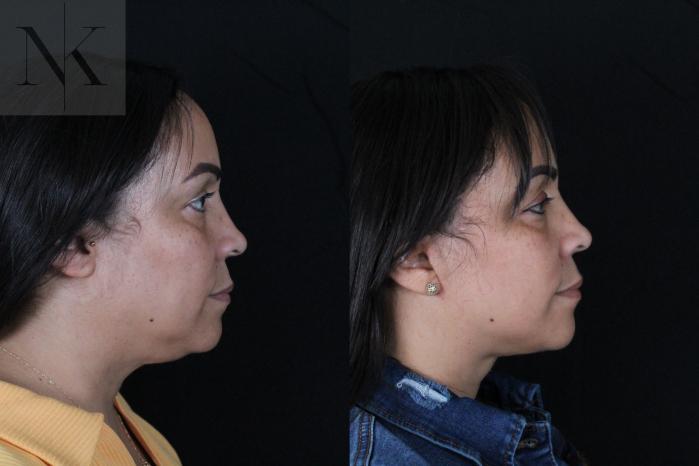 Before & After Deep Plane Facelift Case 212 Right Side View in Wethersfield, Hartford, Nebraska