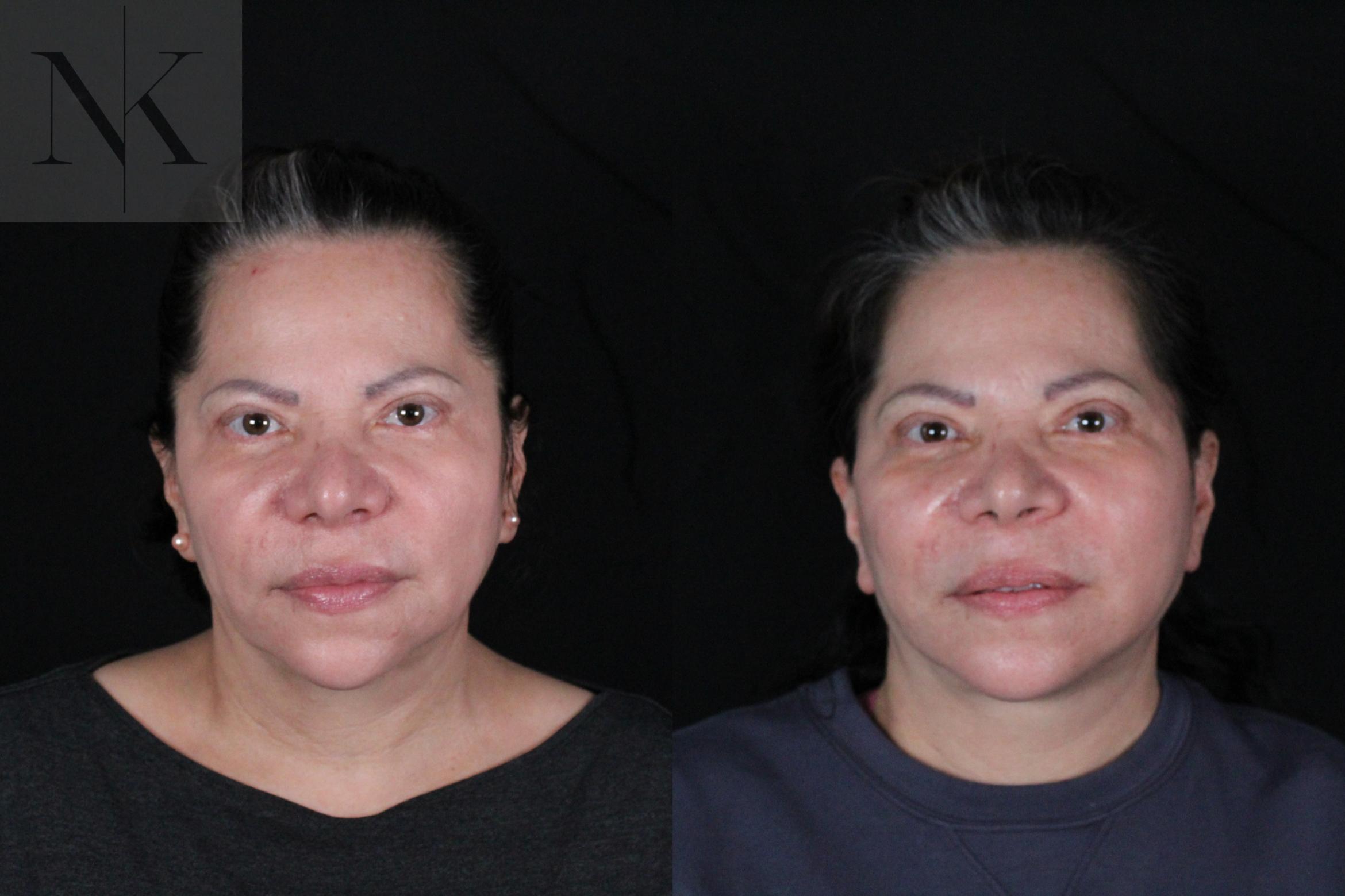 Before & After Deep Plane Facelift Case 213 Front View in Wethersfield, Hartford, Nebraska