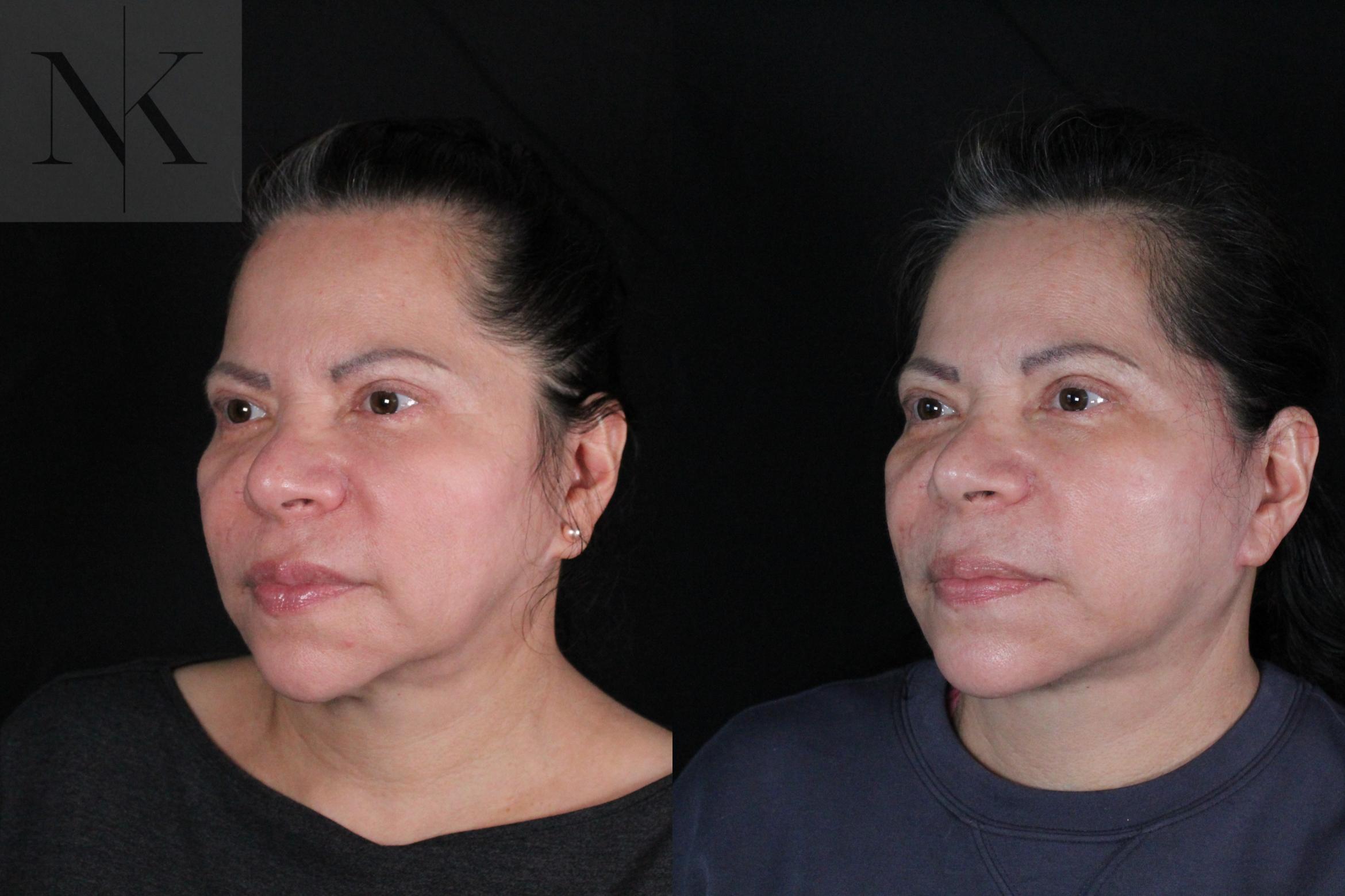 Before & After Deep Plane Facelift Case 213 Left Oblique View in Wethersfield, Hartford, Nebraska