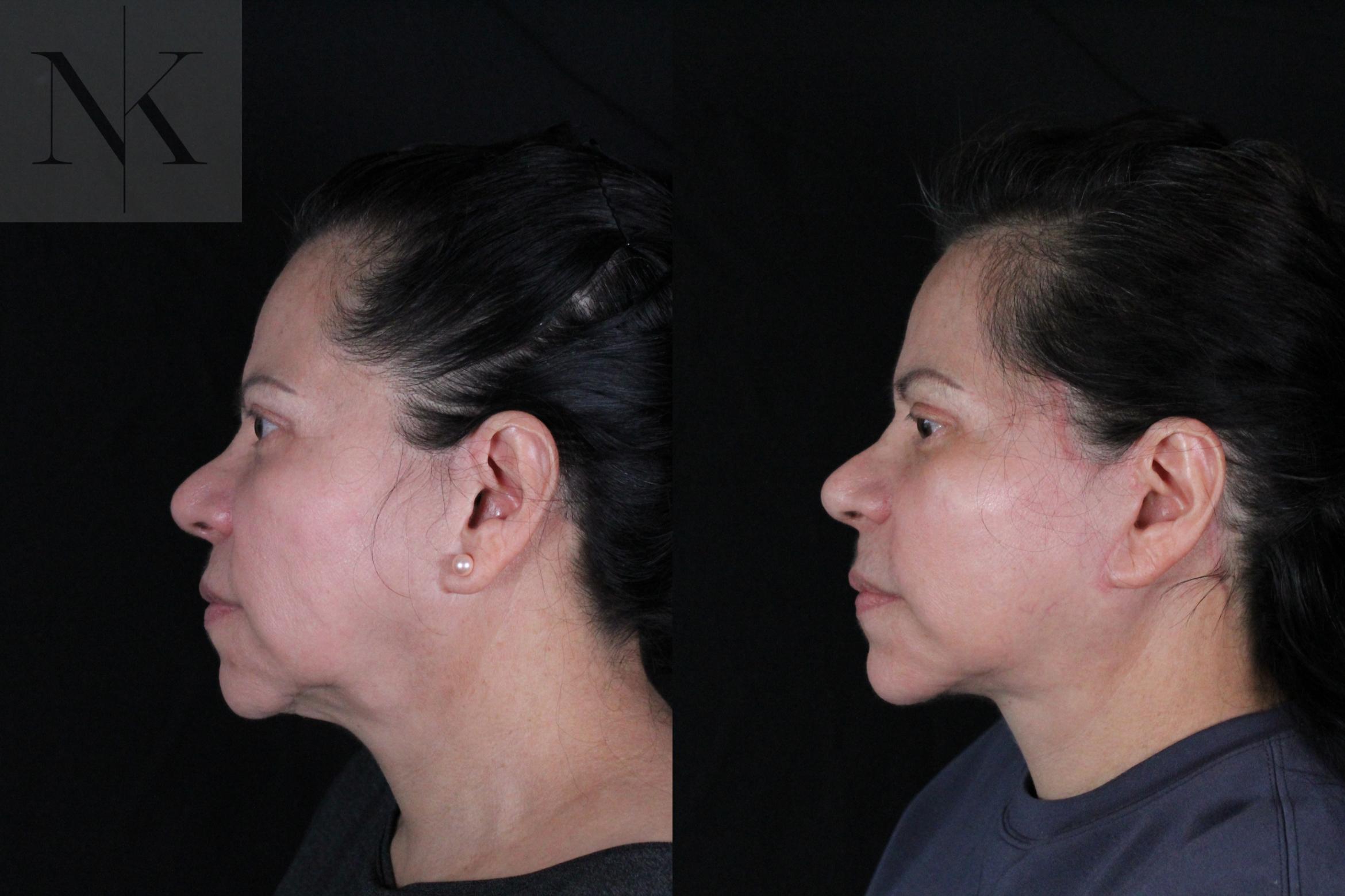 Before & After Deep Plane Facelift Case 213 Left Side View in Wethersfield, Hartford, Nebraska