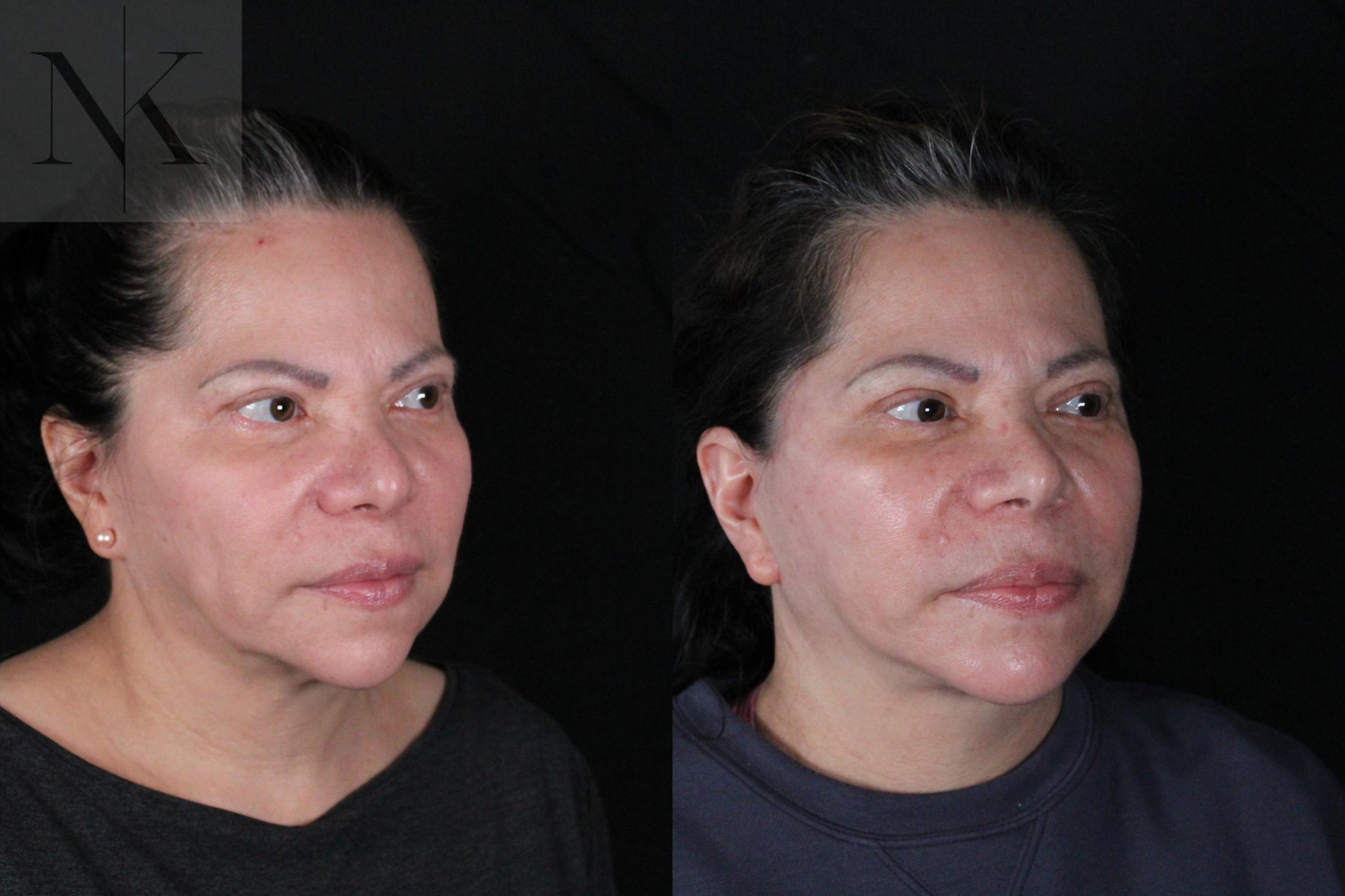 Before & After Deep Plane Facelift Case 213 Right Oblique View in Wethersfield, Hartford, Nebraska