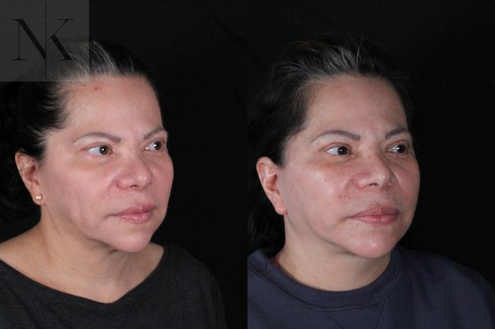 Before & After Deep Plane Facelift Case 213 Right Oblique View in Wethersfield, Hartford, Nebraska