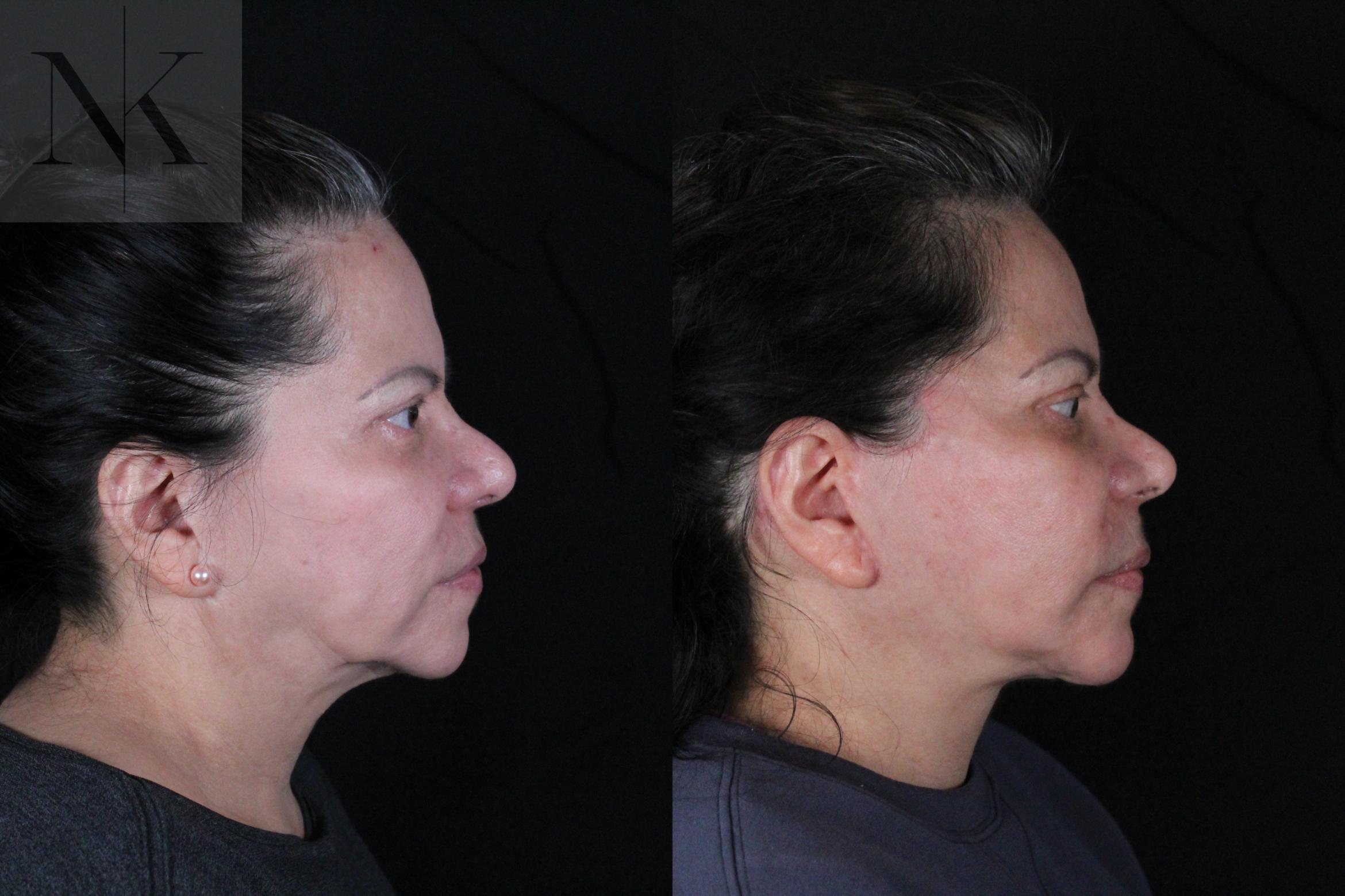Before & After Deep Plane Facelift Case 213 Right Side View in Wethersfield, Hartford, Nebraska