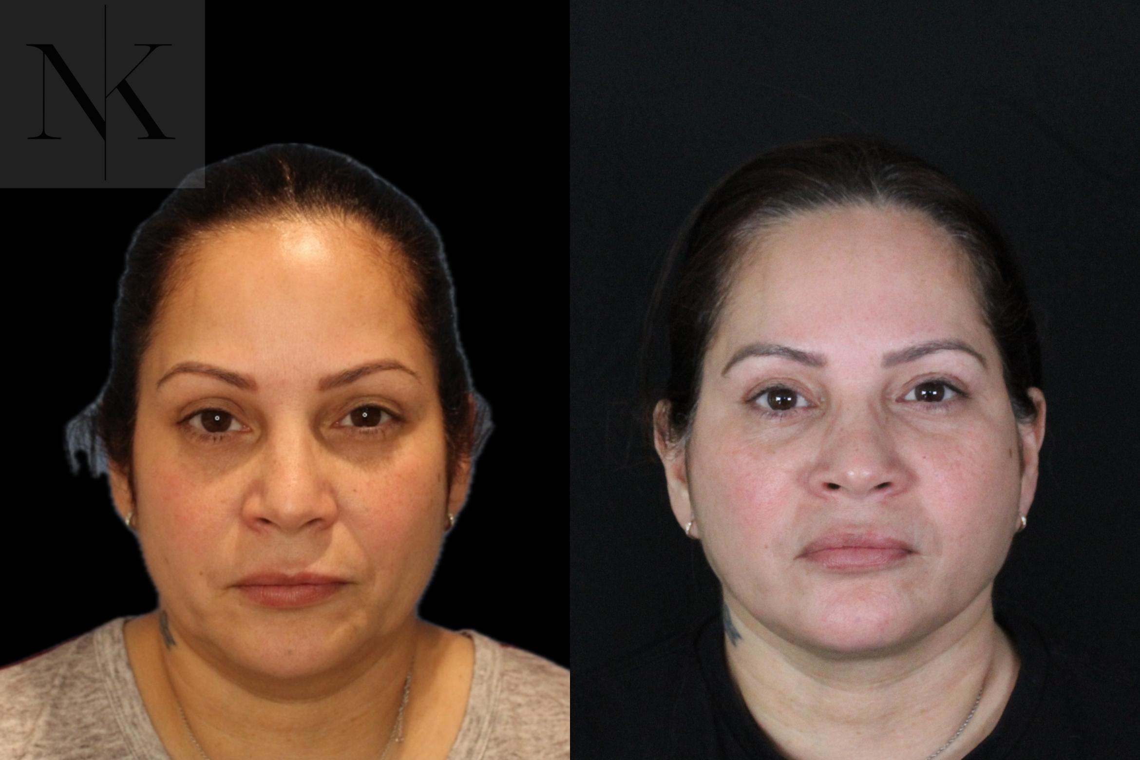 Before & After Deep Plane Facelift Case 214 Front View in Wethersfield, Hartford, Nebraska