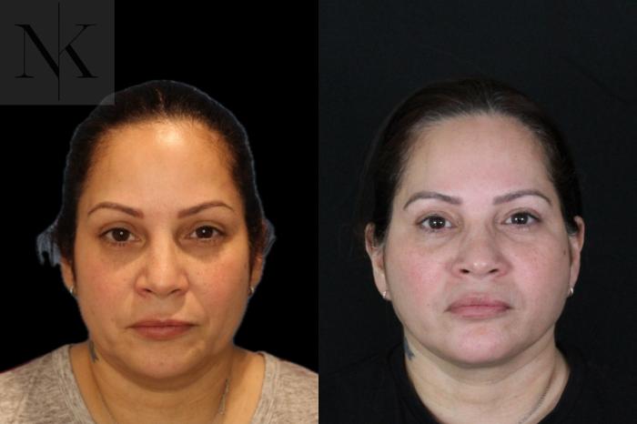 Before & After Deep Plane Facelift Case 214 Front View in Wethersfield, Hartford, Nebraska