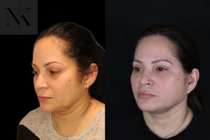 Before & After Deep Plane Facelift Case 214 Left Oblique View in Wethersfield, Hartford, Nebraska
