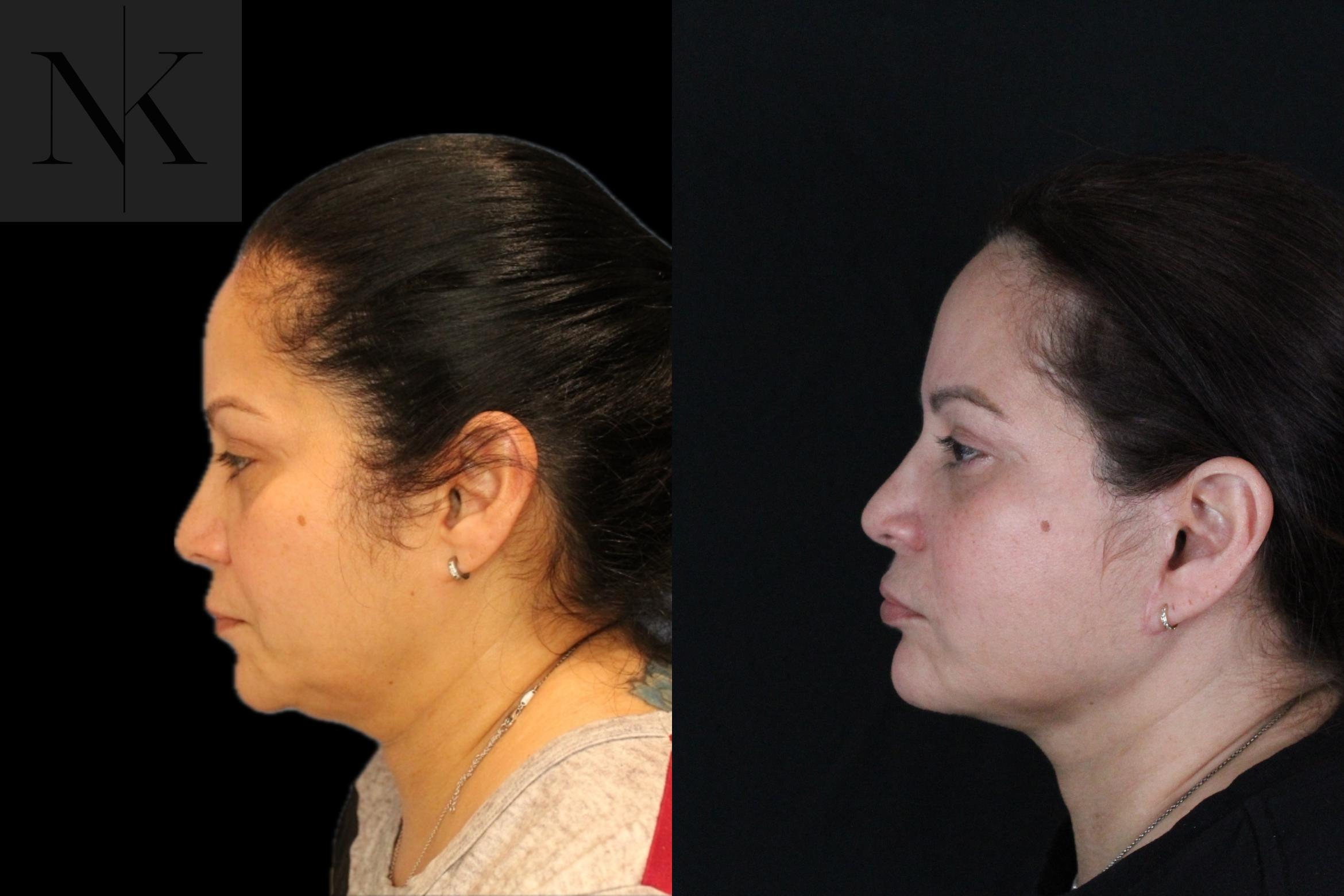 Before & After Deep Plane Facelift Case 214 Left Side View in Wethersfield, Hartford, Nebraska