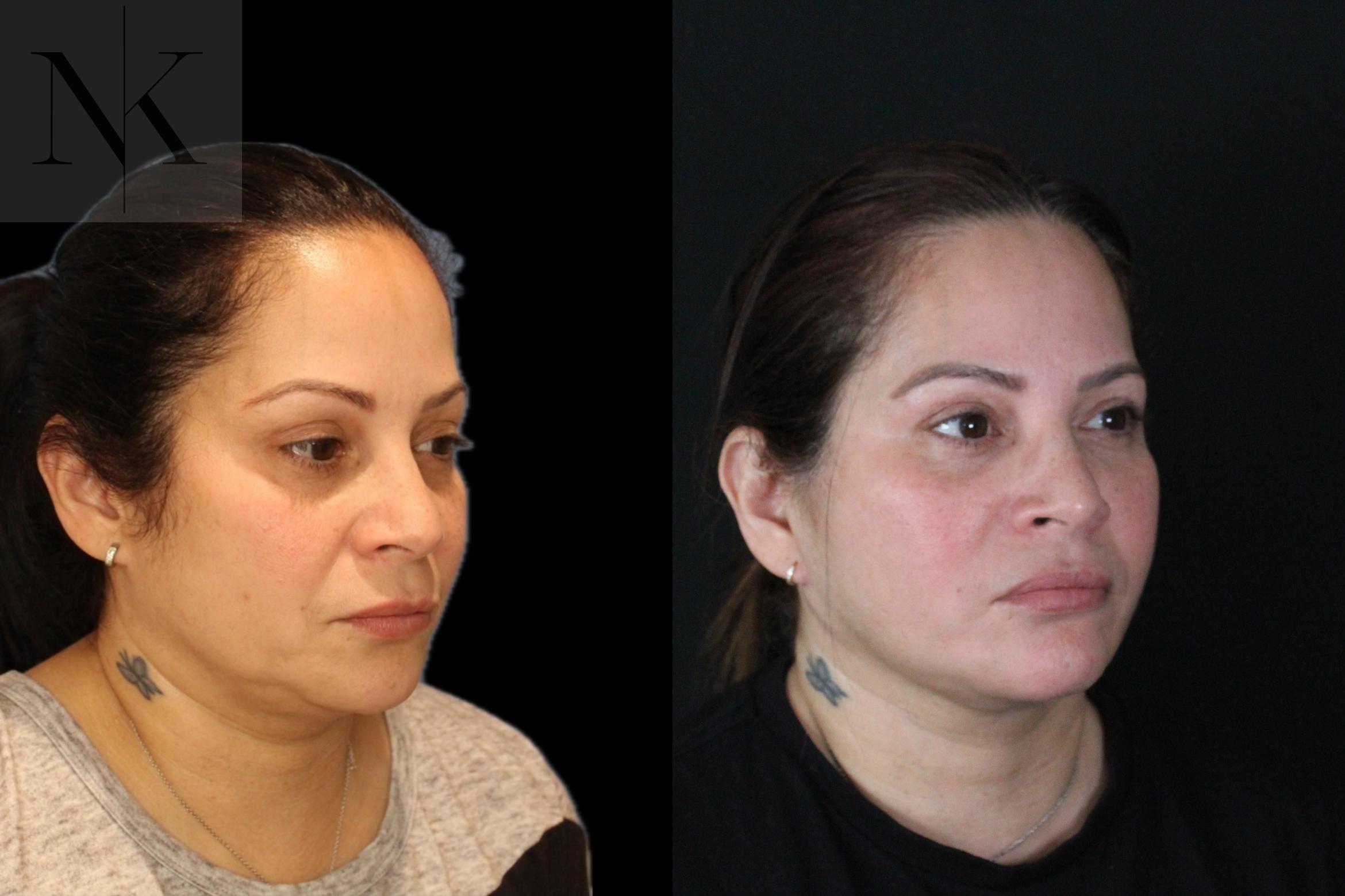 Before & After Deep Plane Facelift Case 214 Right Oblique View in Wethersfield, Hartford, Nebraska