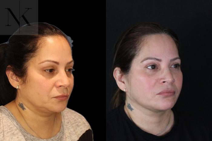 Before & After Deep Plane Facelift Case 214 Right Oblique View in Wethersfield, Hartford, Nebraska