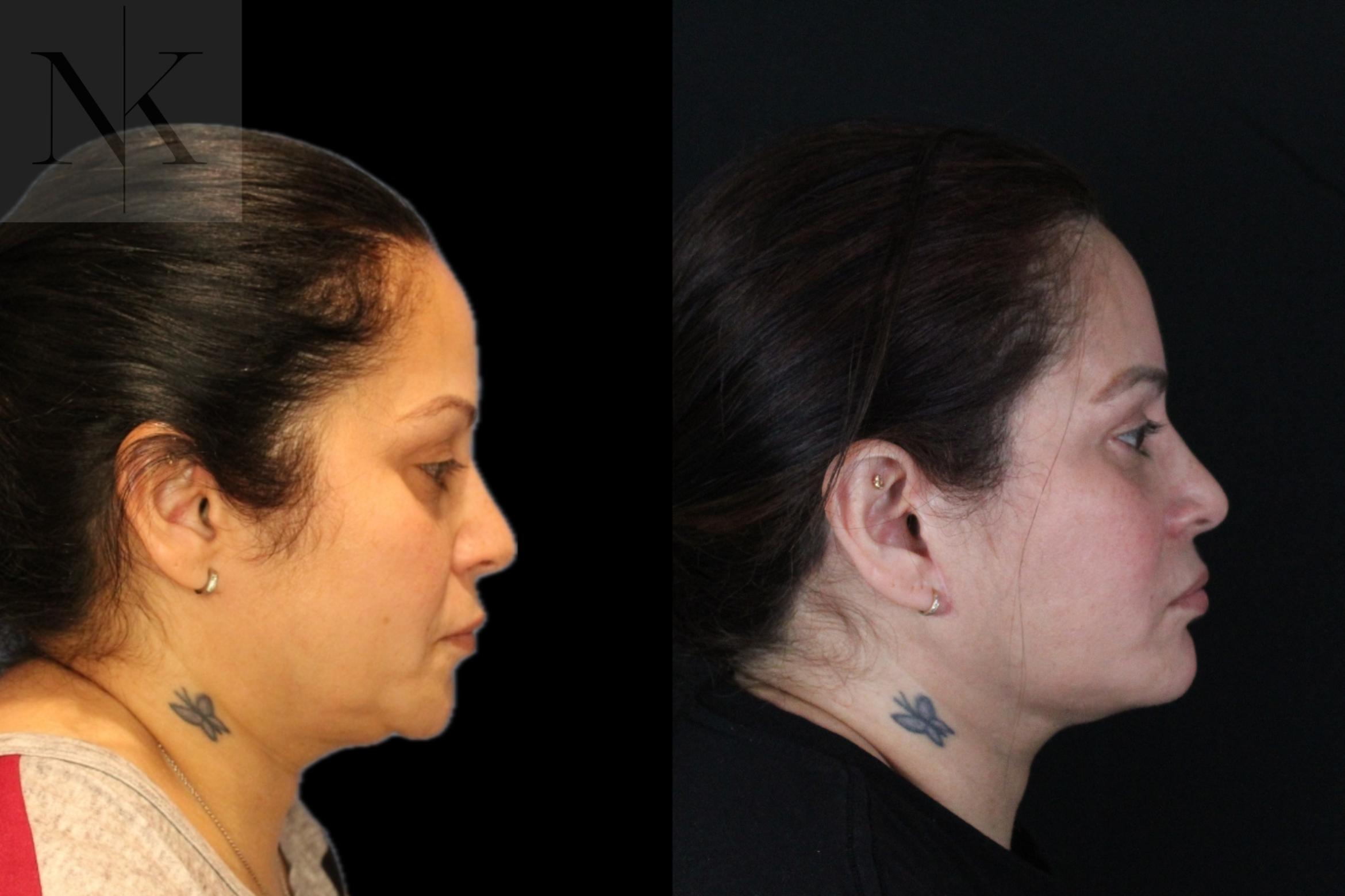 Before & After Deep Plane Facelift Case 214 Right Side View in Wethersfield, Hartford, Nebraska