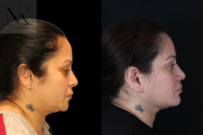 Before & After Deep Plane Facelift Case 214 Right Side View in Wethersfield, Hartford, Nebraska