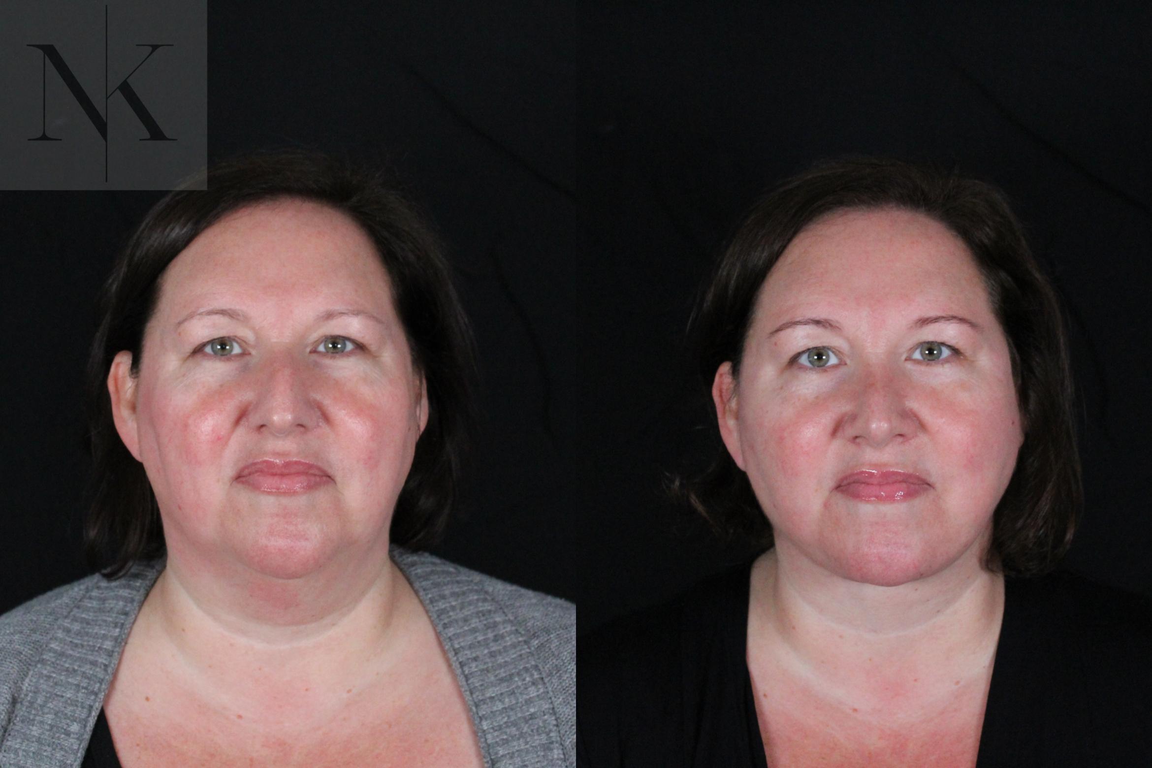 Before & After Deep Plane Facelift Case 215 Front View in Wethersfield, Hartford, Nebraska
