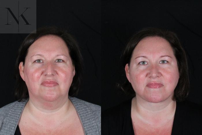 Before & After Deep Plane Facelift Case 215 Front View in Wethersfield, Hartford, Nebraska