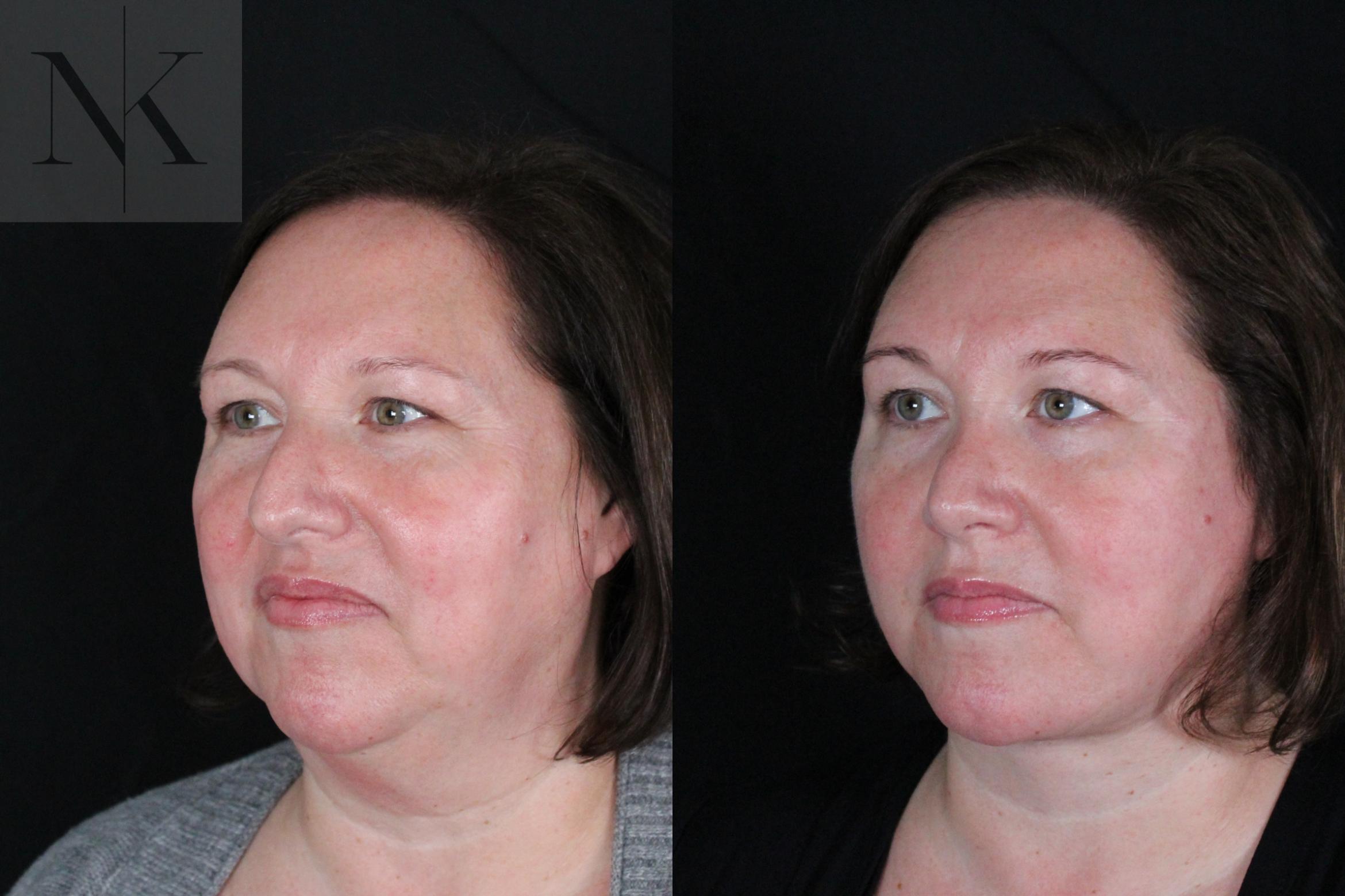 Before & After Deep Plane Facelift Case 215 Left Oblique View in Wethersfield, Hartford, Nebraska