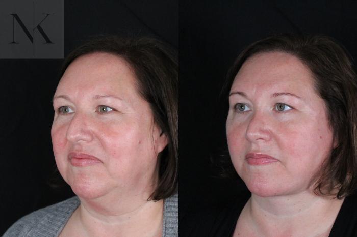 Before & After Deep Plane Facelift Case 215 Left Oblique View in Wethersfield, Hartford, Nebraska