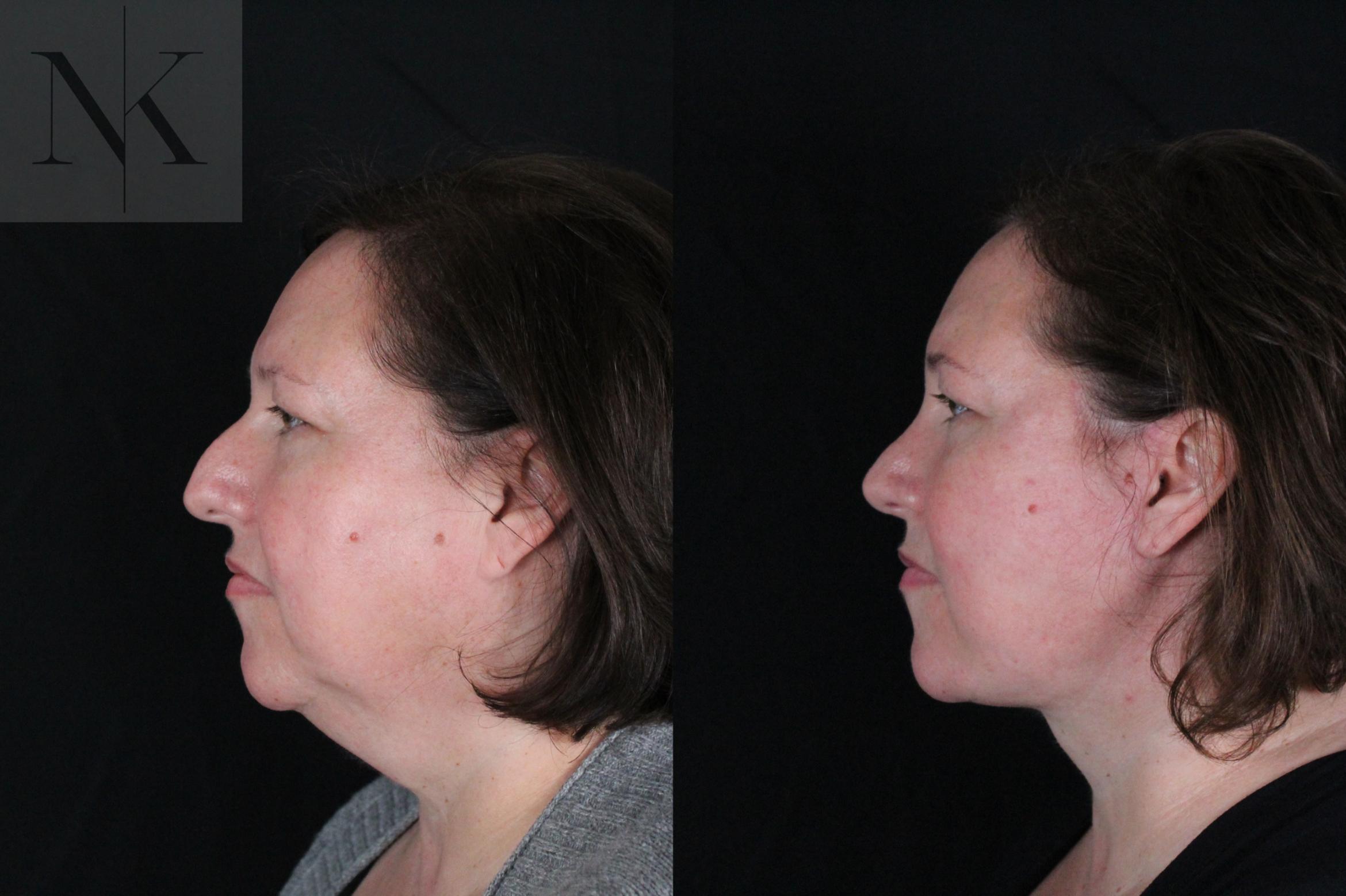 Before & After Deep Plane Facelift Case 215 Left Side View in Wethersfield, Hartford, Nebraska