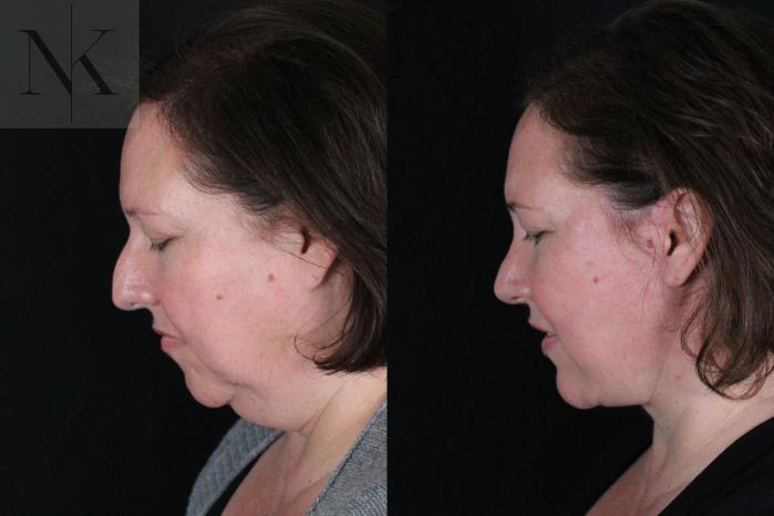 Before & After Deep Plane Facelift Case 215 Left Side Down View in Wethersfield, Hartford, Nebraska