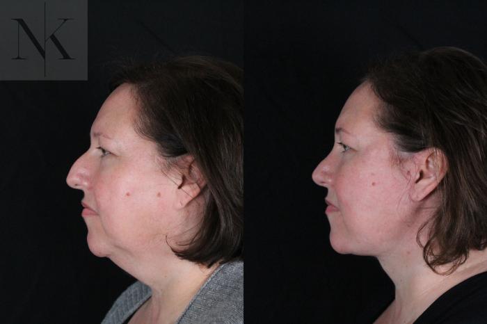 Before & After Deep Plane Facelift Case 215 Left Side View in Wethersfield, Hartford, Nebraska