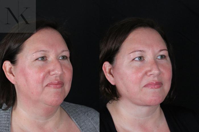 Before & After Deep Plane Facelift Case 215 Right Oblique View in Wethersfield, Hartford, Nebraska