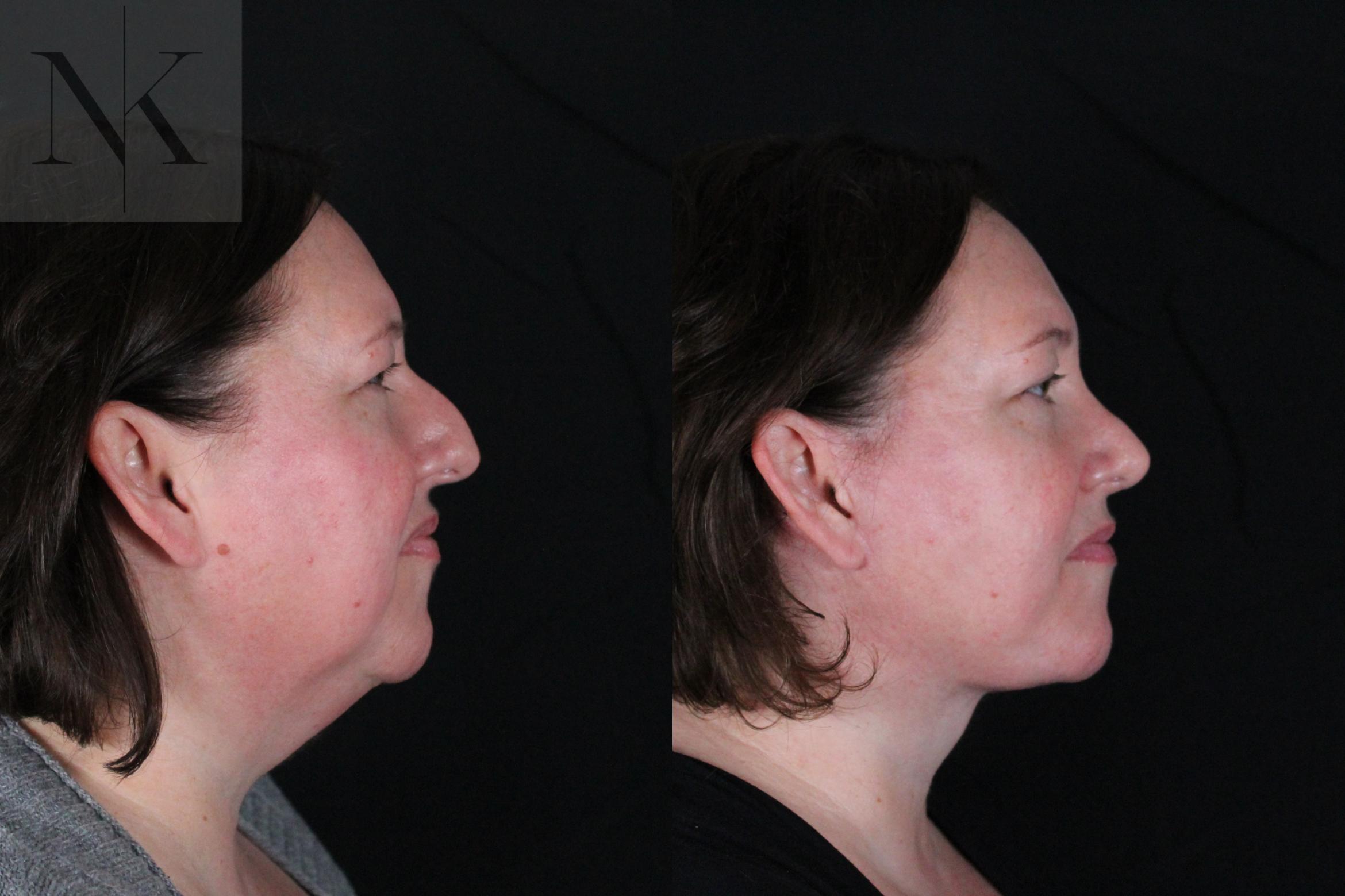 Before & After Deep Plane Facelift Case 215 Right Side View in Wethersfield, Hartford, Nebraska