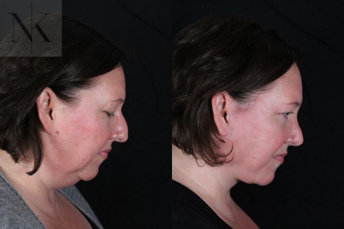 Before & After Deep Plane Facelift Case 215 Right Side Down View in Wethersfield, Hartford, Nebraska