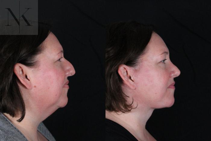 Before & After Deep Plane Facelift Case 215 Right Side View in Wethersfield, Hartford, Nebraska