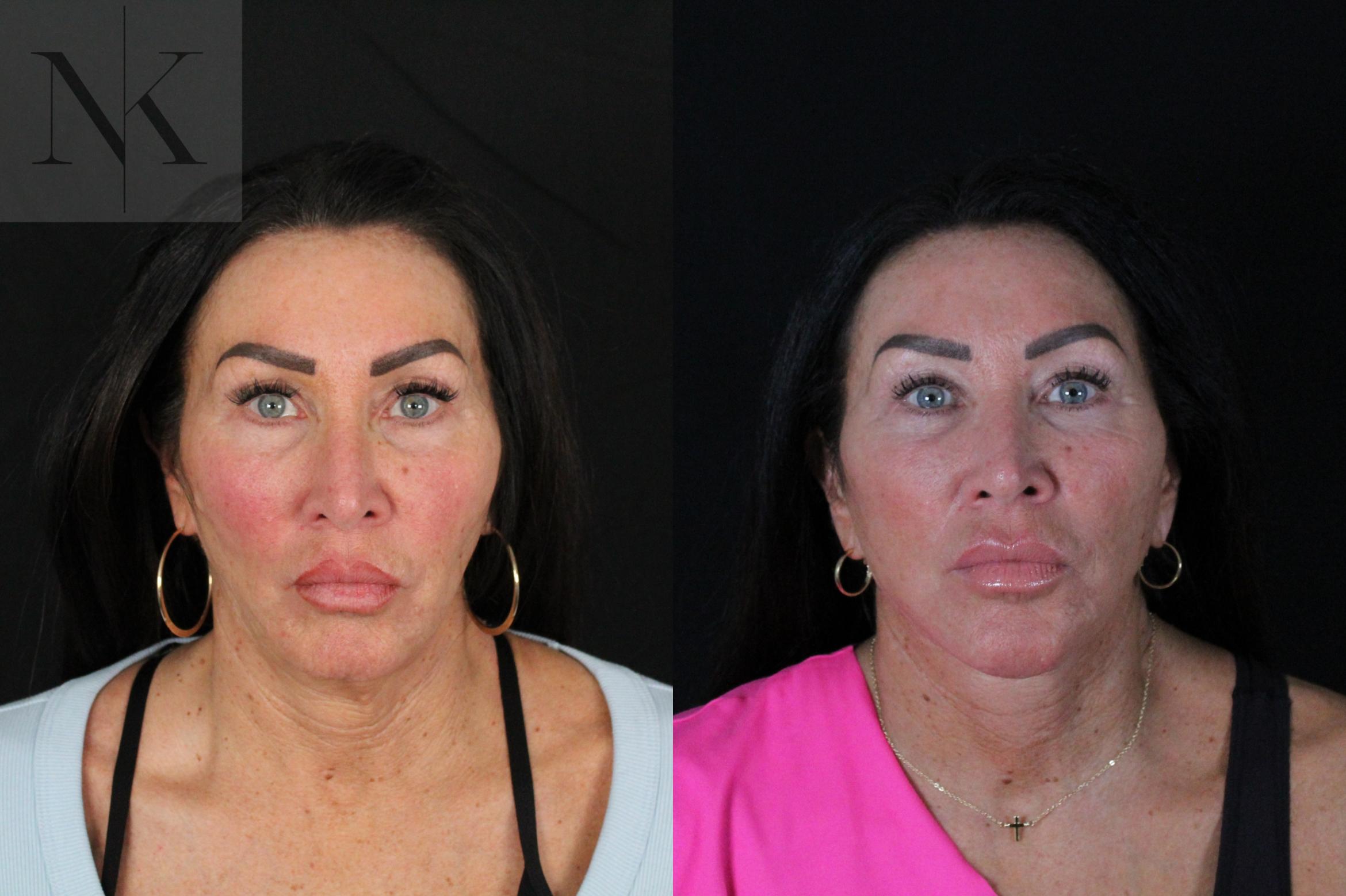 Before & After Deep Plane Facelift Case 216 Front View in Wethersfield, Hartford, Nebraska