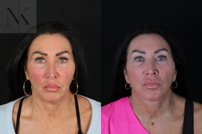 Before & After Deep Plane Facelift Case 216 Front View in Wethersfield, Hartford, Nebraska
