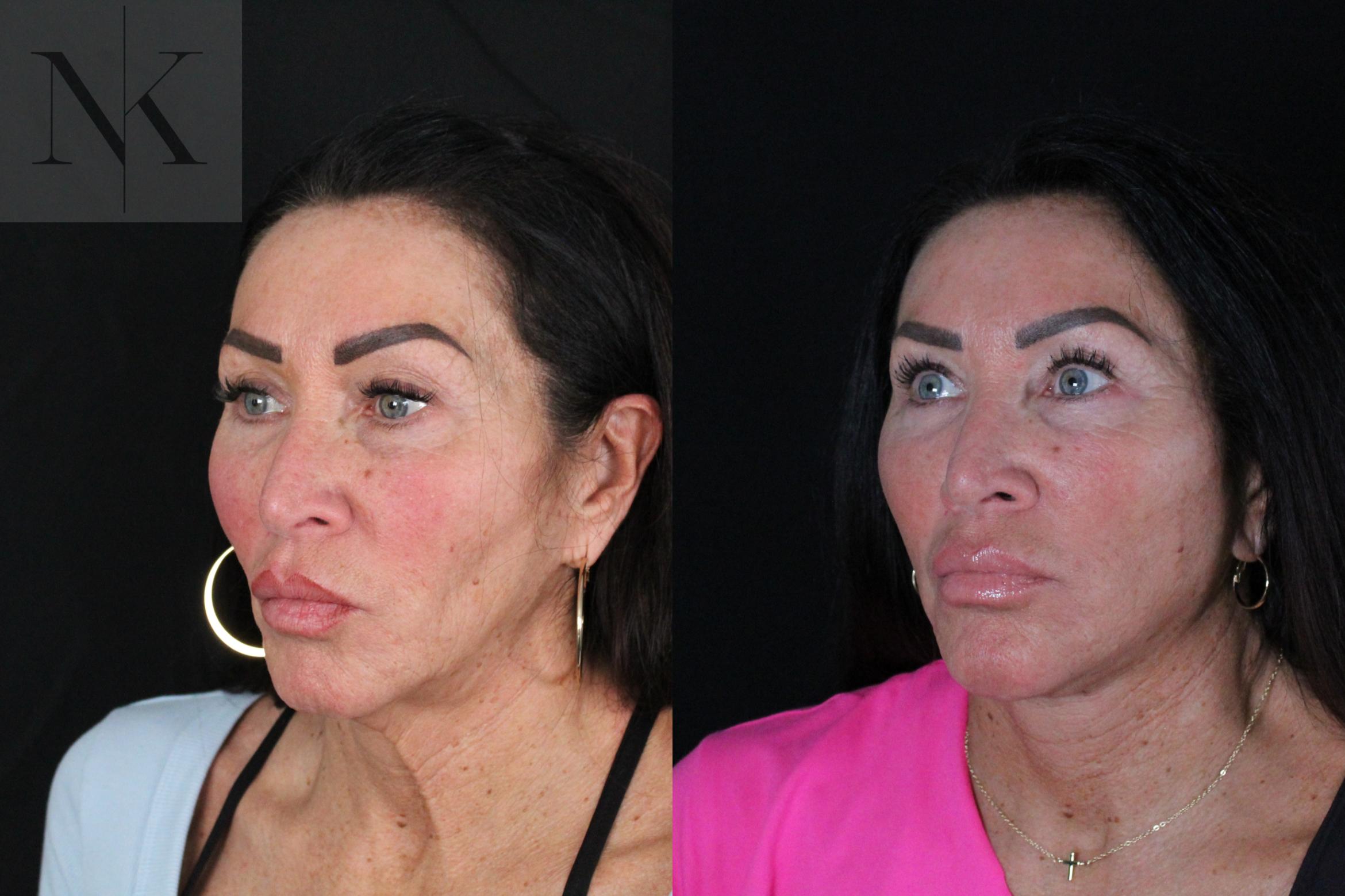 Before & After Deep Plane Facelift Case 216 Left Oblique View in Wethersfield, Hartford, Nebraska