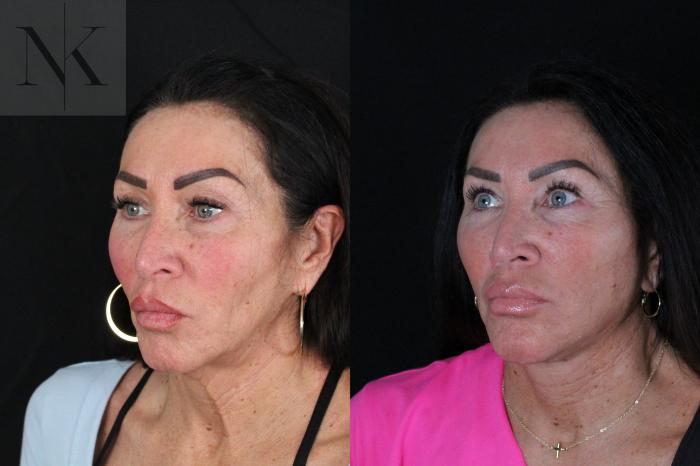 Before & After Deep Plane Facelift Case 216 Left Oblique View in Wethersfield, Hartford, Nebraska