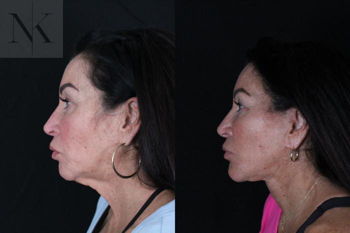 Before & After Deep Plane Facelift Case 216 Left Side View in Wethersfield, Hartford, Nebraska