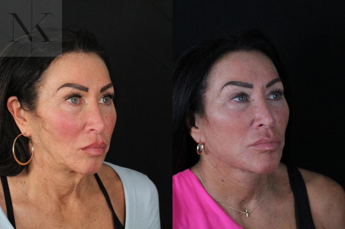 Before & After Deep Plane Facelift Case 216 Right Oblique View in Wethersfield, Hartford, Nebraska