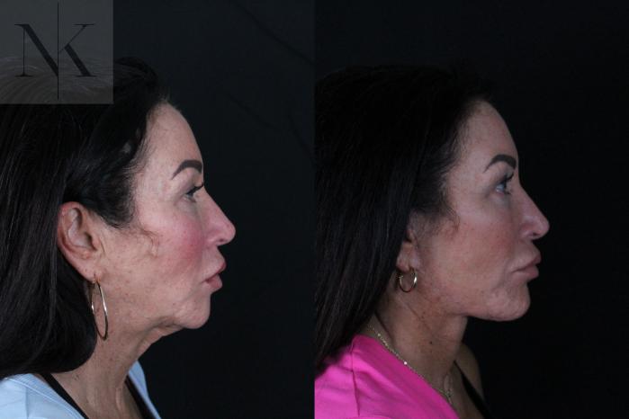 Before & After Deep Plane Facelift Case 216 Right Side View in Wethersfield, Hartford, Nebraska