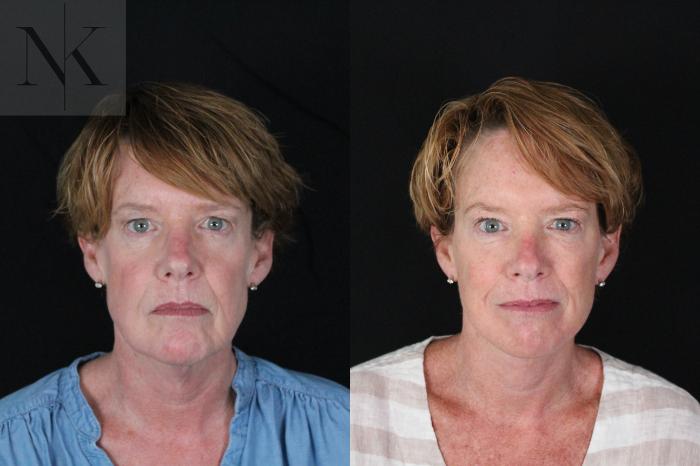 Before & After Deep Plane Facelift Case 217 Front View in Wethersfield, Hartford, Nebraska