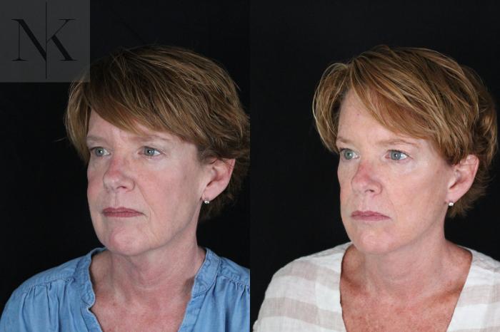 Before & After Deep Plane Facelift Case 217 Left Oblique View in Wethersfield, Hartford, Nebraska