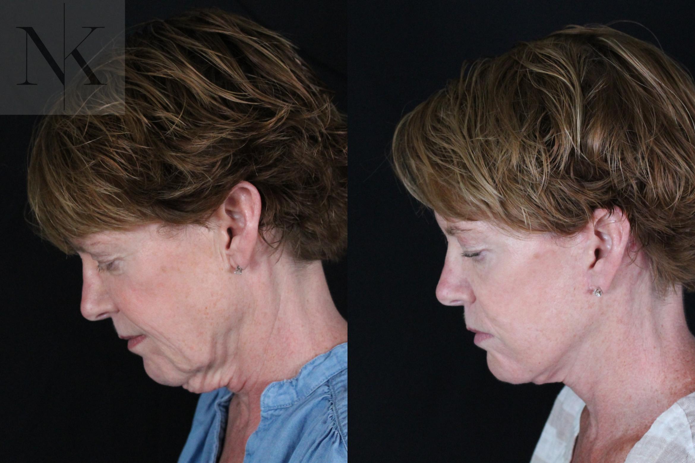Before & After Deep Plane Facelift Case 217 Left Side Down View in Wethersfield, Hartford, Nebraska