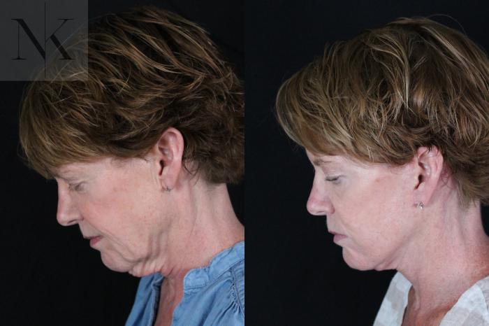 Before & After Deep Plane Facelift Case 217 Left Side Down View in Wethersfield, Hartford, Nebraska