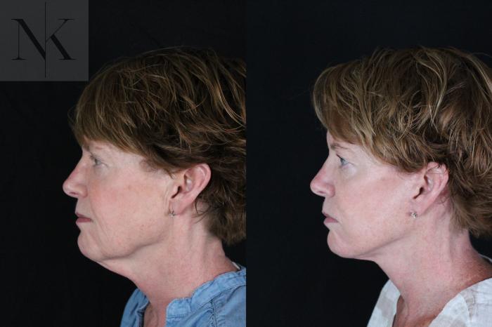 Before & After Deep Plane Facelift Case 217 Left Side View in Wethersfield, Hartford, Nebraska