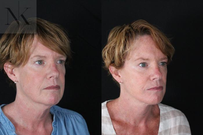 Before & After Deep Plane Facelift Case 217 Right Oblique View in Wethersfield, Hartford, Nebraska