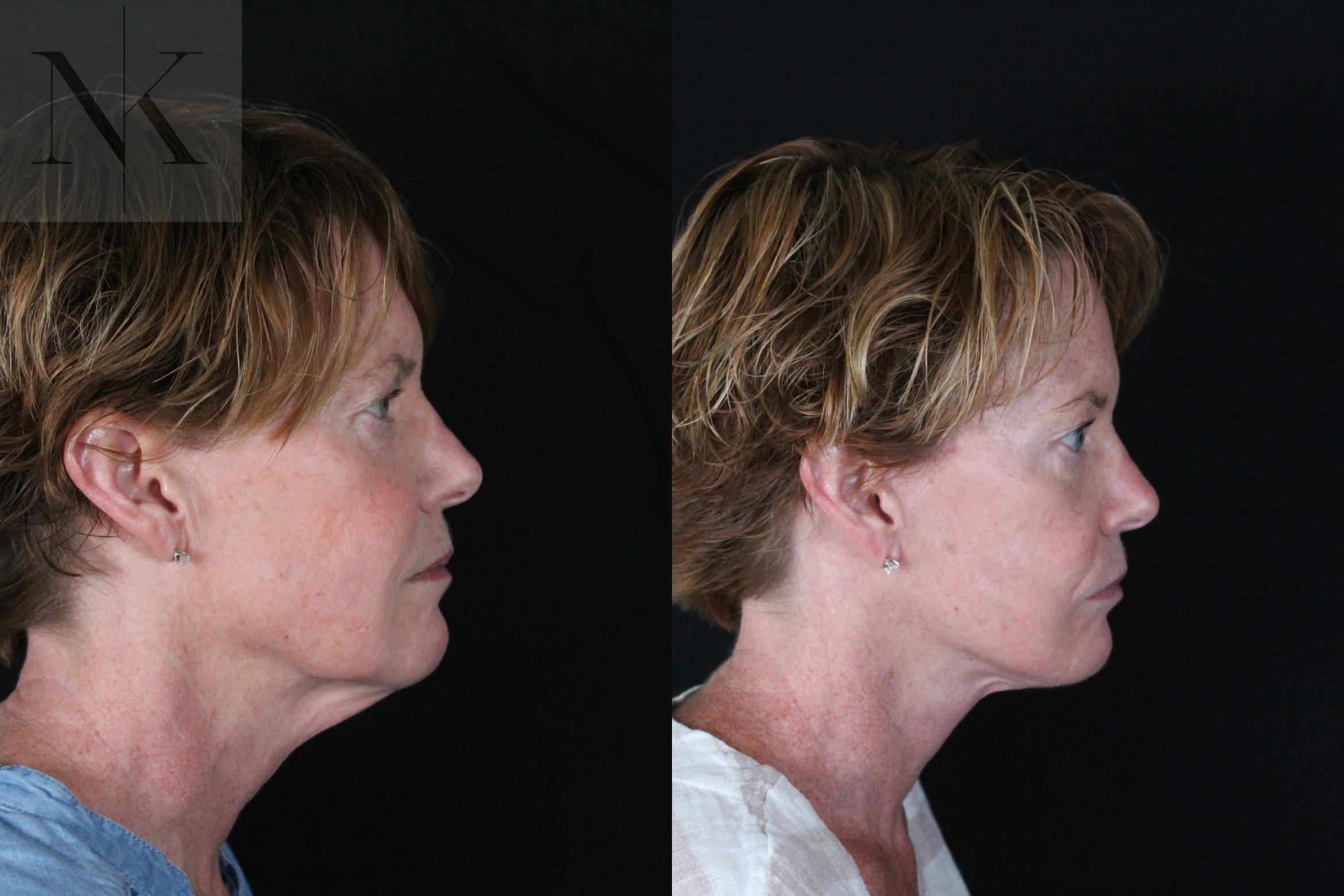 Before & After Deep Plane Facelift Case 217 Right Side View in Wethersfield, Hartford, Nebraska