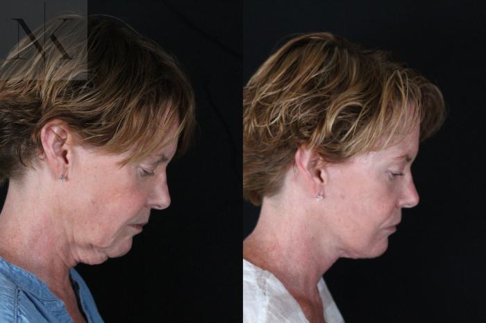 Before & After Deep Plane Facelift Case 217 Right Side Down View in Wethersfield, Hartford, Nebraska