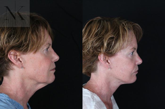 Before & After Deep Plane Facelift Case 217 Right Side View in Wethersfield, Hartford, Nebraska
