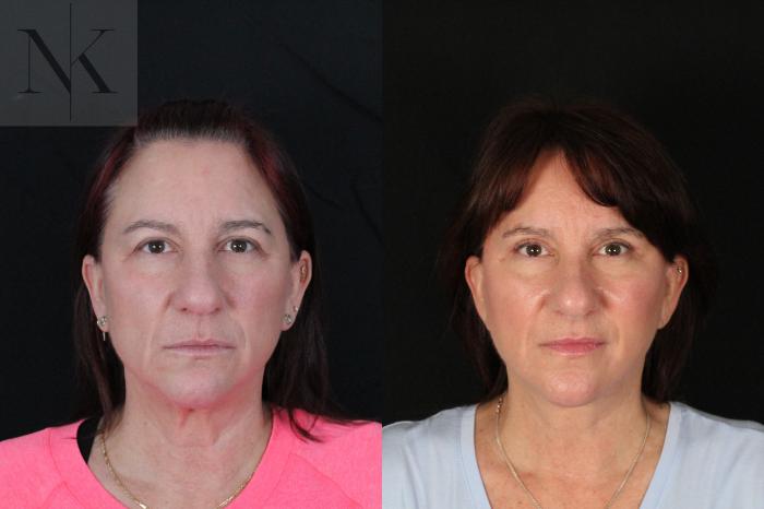 Before & After Deep Plane Facelift Case 218 Front View in Wethersfield, Hartford, Nebraska