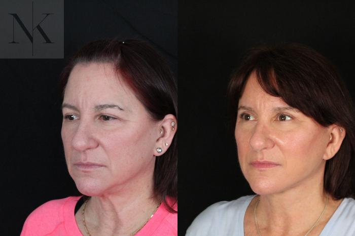 Before & After Deep Plane Facelift Case 218 Left Oblique View in Wethersfield, Hartford, Nebraska