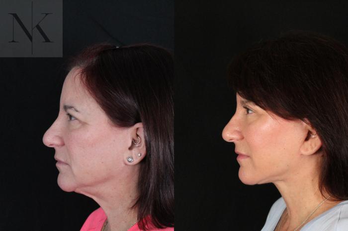 Before & After Deep Plane Facelift Case 218 Left Side View in Wethersfield, Hartford, Nebraska