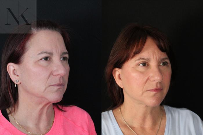 Before & After Deep Plane Facelift Case 218 Right Oblique View in Wethersfield, Hartford, Nebraska
